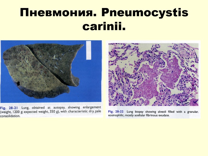 Пневмония. Pneumocystis carinii.